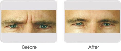 Botox BA 01