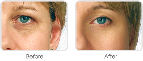 Botox BA 02