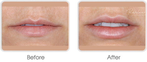 Dermal Fillers BA 01