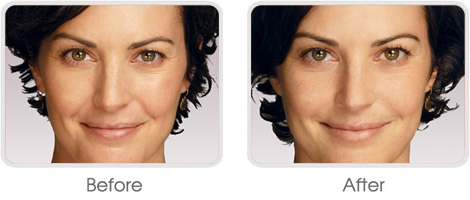 Dermal Fillers BA 02