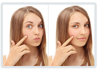 Dermal Needling