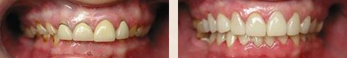 Dentist Clinton - Before After Image