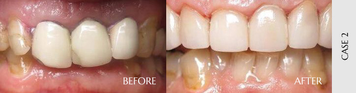 Before After Case O2