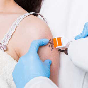 Safe laser tattoo removal from a doctor in Huntington