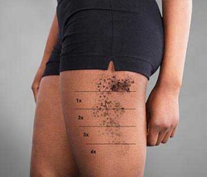 Dr. Roger Koreen explains how laser tattoo removal works