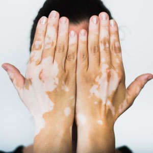Selective laser therapy with XTRAC Excimer treatment for Vitiligo in Huntington, NY