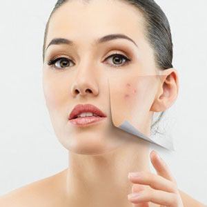 Huntington, NY area patients ask their doctor, should I get a chemical peel?