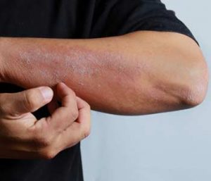 Rashes on man hand