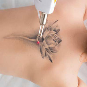 Goodbye unwanted ink: Huntington, NY clinic offers laser tattoo removal treatments