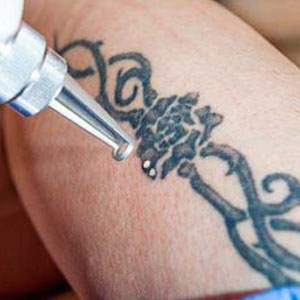 Conventional tattoo removals do hurt, but there is a better way to remove them in Huntington