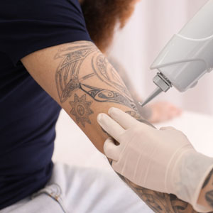 Patients in Huntington, NY ask, “Is laser tattoo removal worth it?”