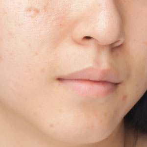 Huntington area patients can use microdermabrasion for acne marks