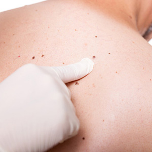 Learn the early signs of skin cancer from Huntington, NY doctor