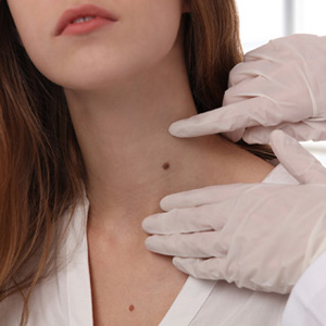 When treating atypical moles in Huntington, NY, we are mindful of individual factors