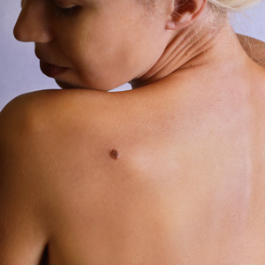 Does an itchy mole require treatment by a Huntington dermatologist?