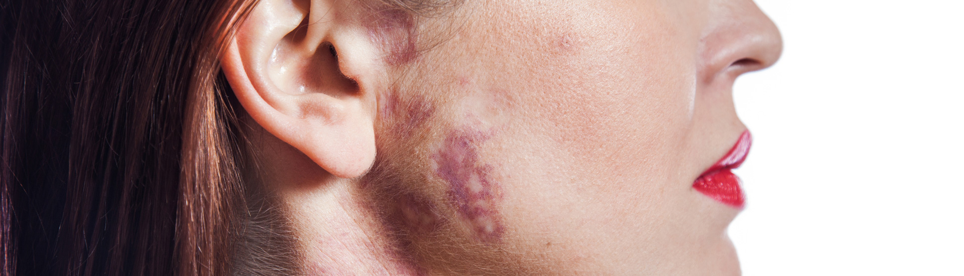 Woman with port wine stains
