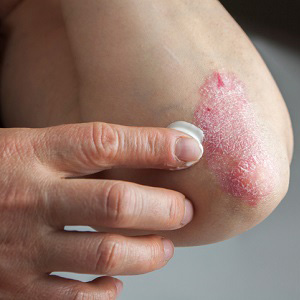 Huntington, NY area patients ask how to treat psoriasis