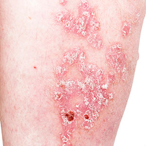 Huntington area dermatologist offers phototherapy for psoriasis