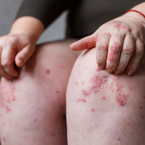 The causes and risk factors of psoriasis are discussed by your dermatologist in Huntington NY