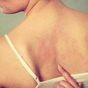 Huntington dermatologist explains common types of skin rashes, their causes and available treatments