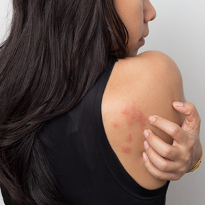 Huntington, NY area patients ask if there is a cure for rashes