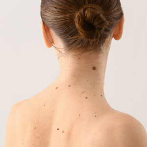 Moles and the potential for a skin cancer diagnosis in Huntington