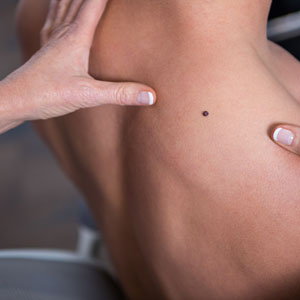 Making the most of your skin cancer screening in Huntington, NY