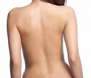 Woman back after tattoo removal