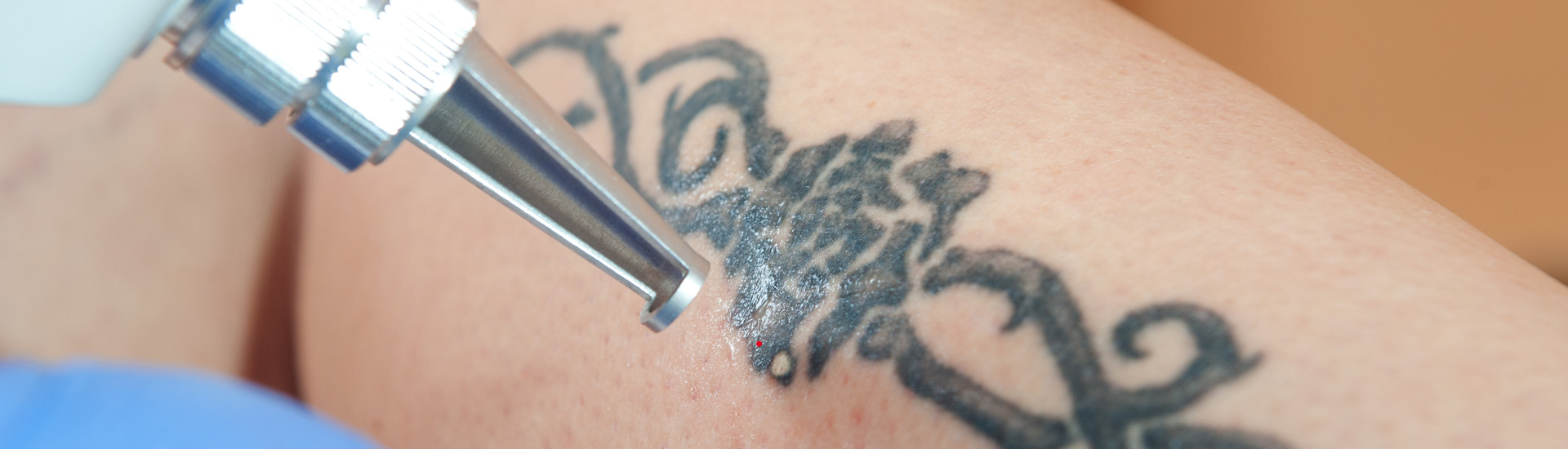 Laser tattoo removal from leg