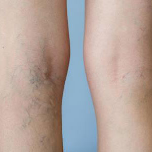Sclerotherapy is a safe method of spider vein removal in Huntington, NY
