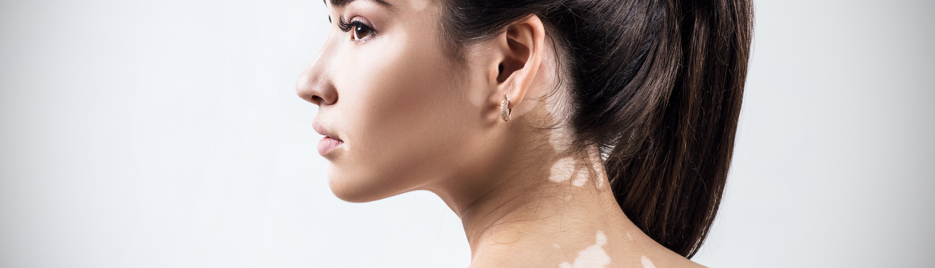 Woman with vitiligo