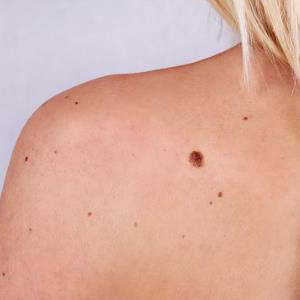 Plantar wart removal from your Huntington, NY dermatologist