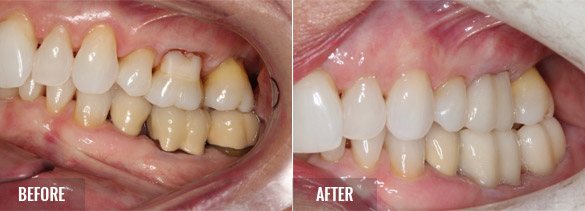 Biologic Shaping Before and After 01