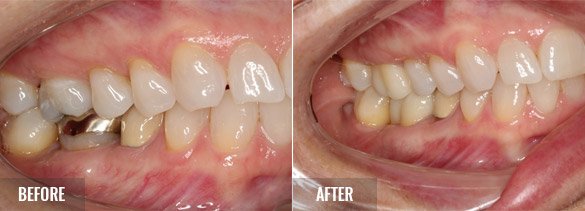Biologic Shaping Before and After 02