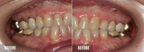 Biologic Shaping Before 03