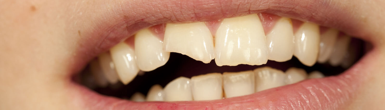 Woman with beautiful mouths and broken tooth