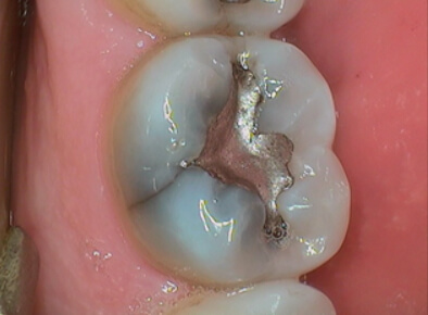 Broken tooth