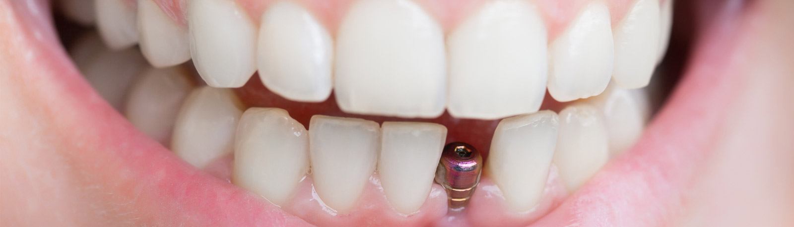 Implant Dentures, FL