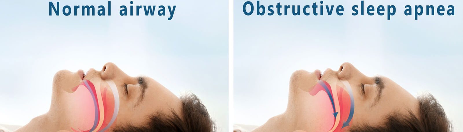 Snore problem concept - Illustration of normal airway and obstructive sleep apnea