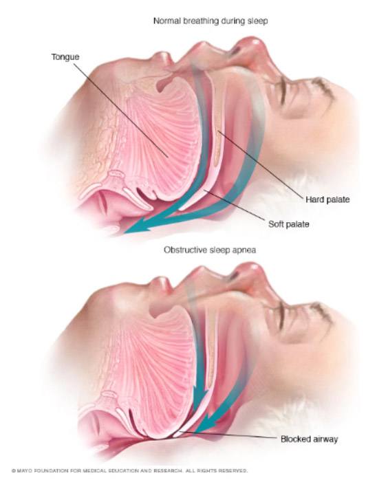 Obstructive Sleep Apnea Symptoms, FL