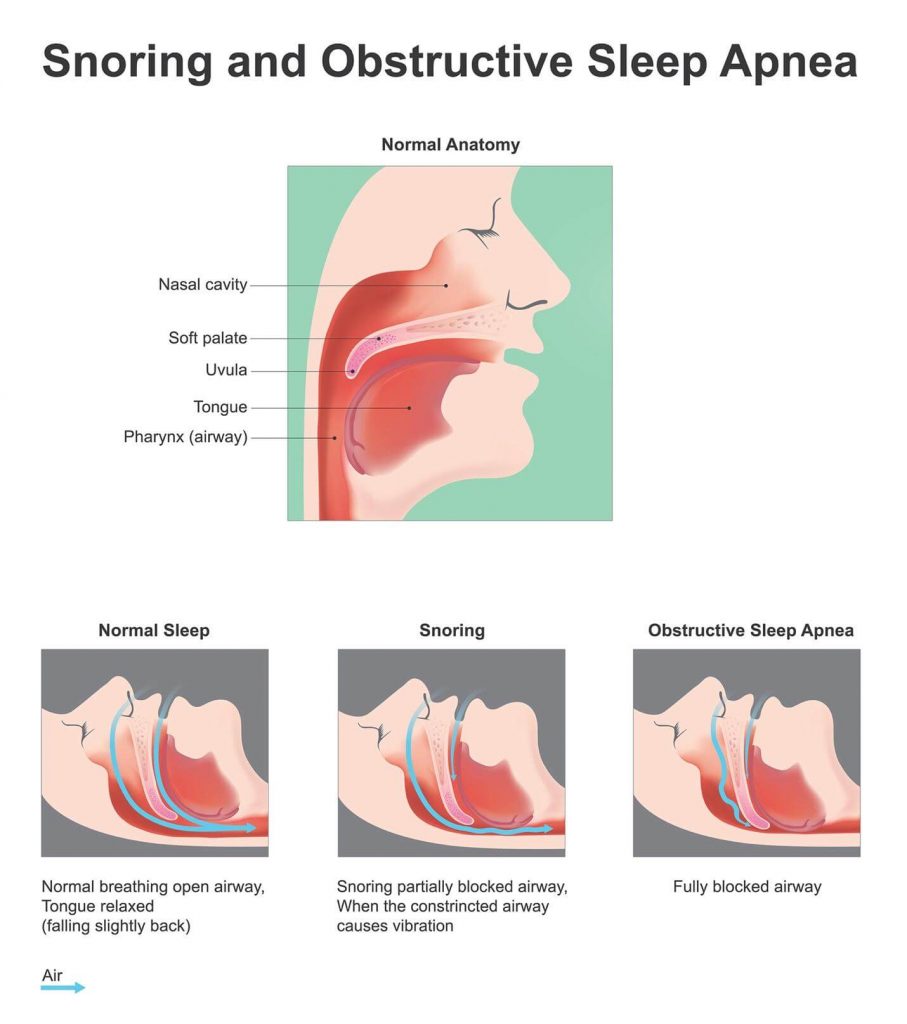 Snoring and obstructive sleep apnea