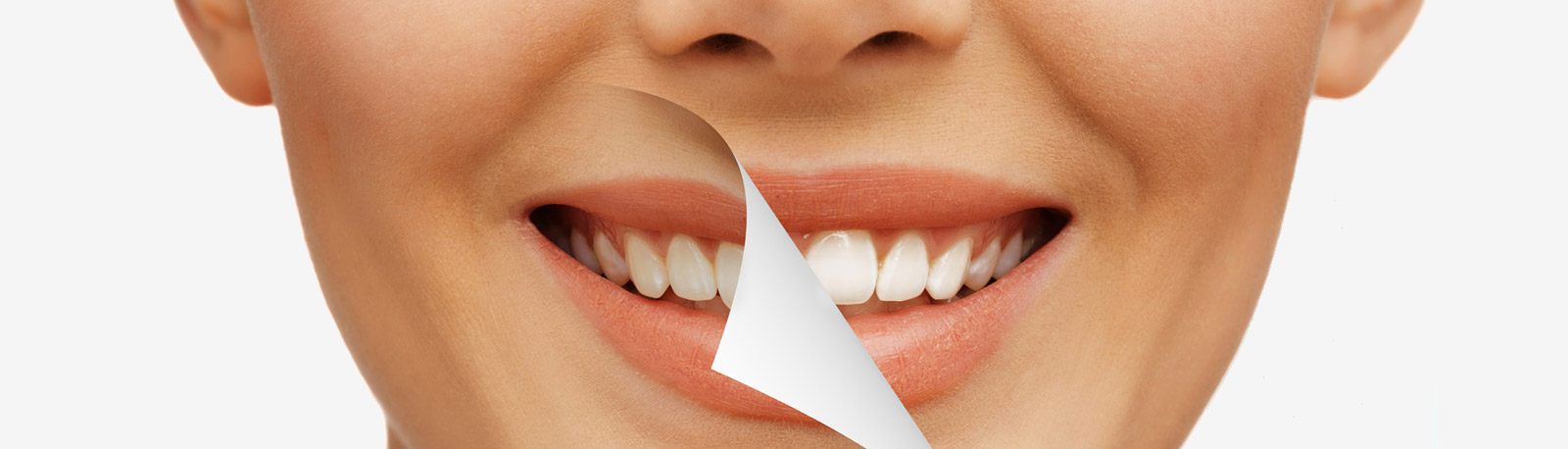 Stained Teeth, FL