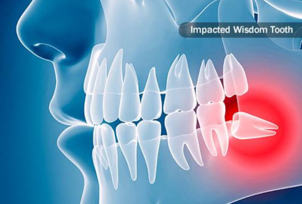Impacted wisdom tooth