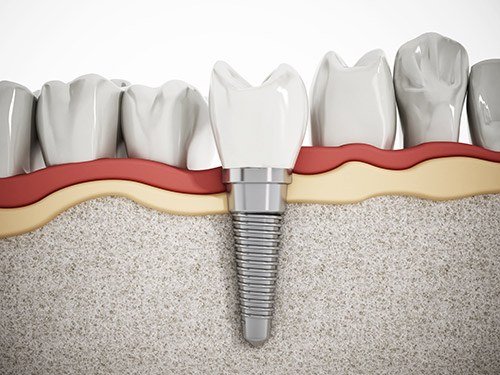 Dental implant structure