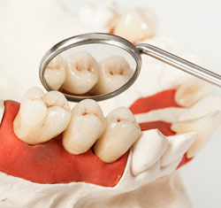 <?php echo $pk;?> - Illustration of Dental crowns