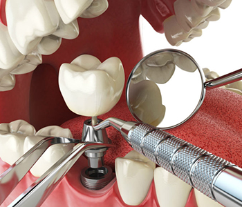 Beverly Hills area dentist Dr. Moldovan Sanda, answers, “Can dental implant be done in one day?”