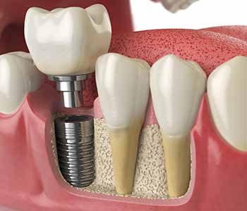 Save your smile with dental implants from a Beverly Hills implant dentist, Dr. Moldovan Sanda.