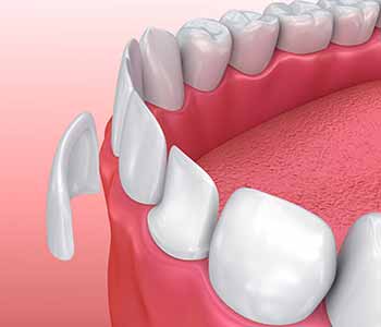 How long do porcelain veneers last, check what Dr. Moldovan Sanda at Beverly Hills Dental Health and Wellness says.