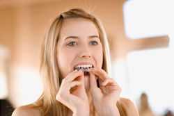 Invisalign Kennesaw - Woman wearing Invisalign
