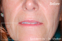 Before and After Austin - Case Study 1